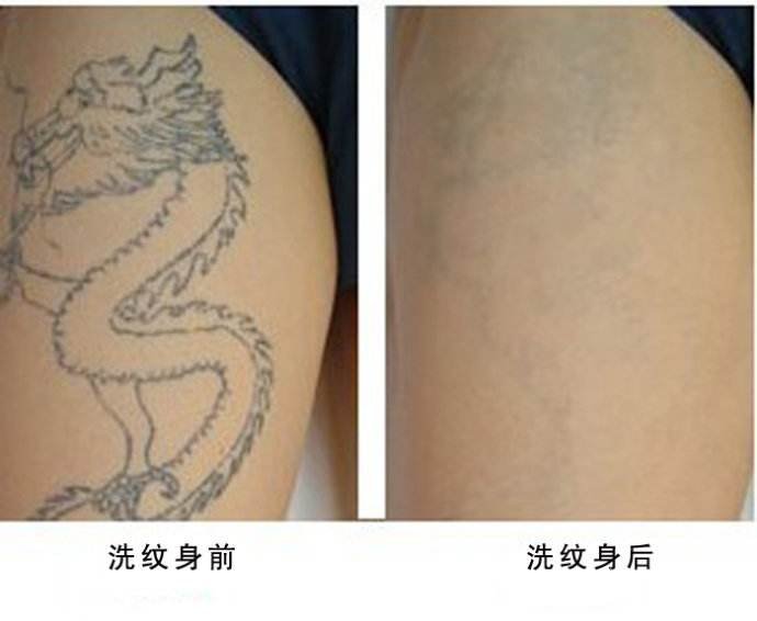 安庆洗纹身